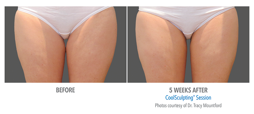 Inner Thighs CoolSculpting