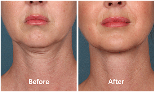 FDA Approved Kybella™ A Safe And Effective Option To Get Rid Of