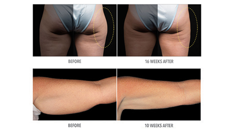 CoolSculpting Before and After