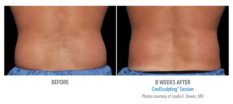 CoolSculpting Flanks Love Handles Tampa