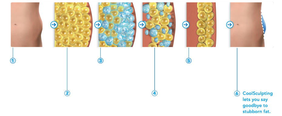 CoolSculpting Faces South Tampa