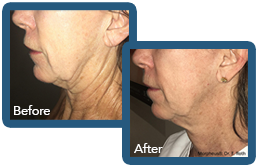 Radiofrequency RF Microneedling Tampa