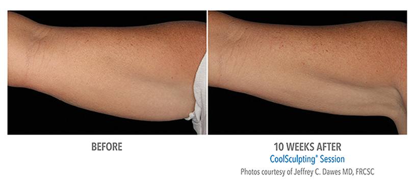 Upper Arms CoolSculpting Tampa